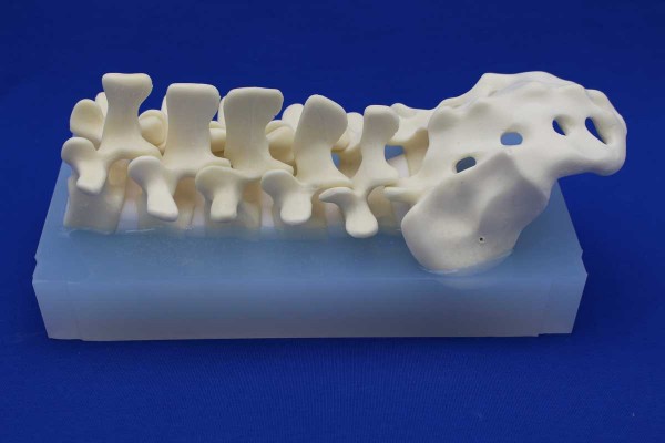 POSTERIOR LUMBAR SPINE INCLUDED ELASTOMER